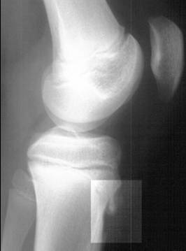 Lateral knee X-ray showing tibial tubercle fragmentation and swelling in Osgood-Schlatter disease