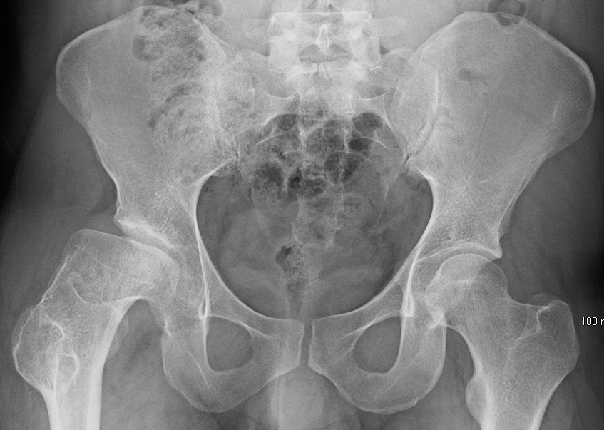 Pelvic X-ray showing Legg-Calve-Perthes disease
