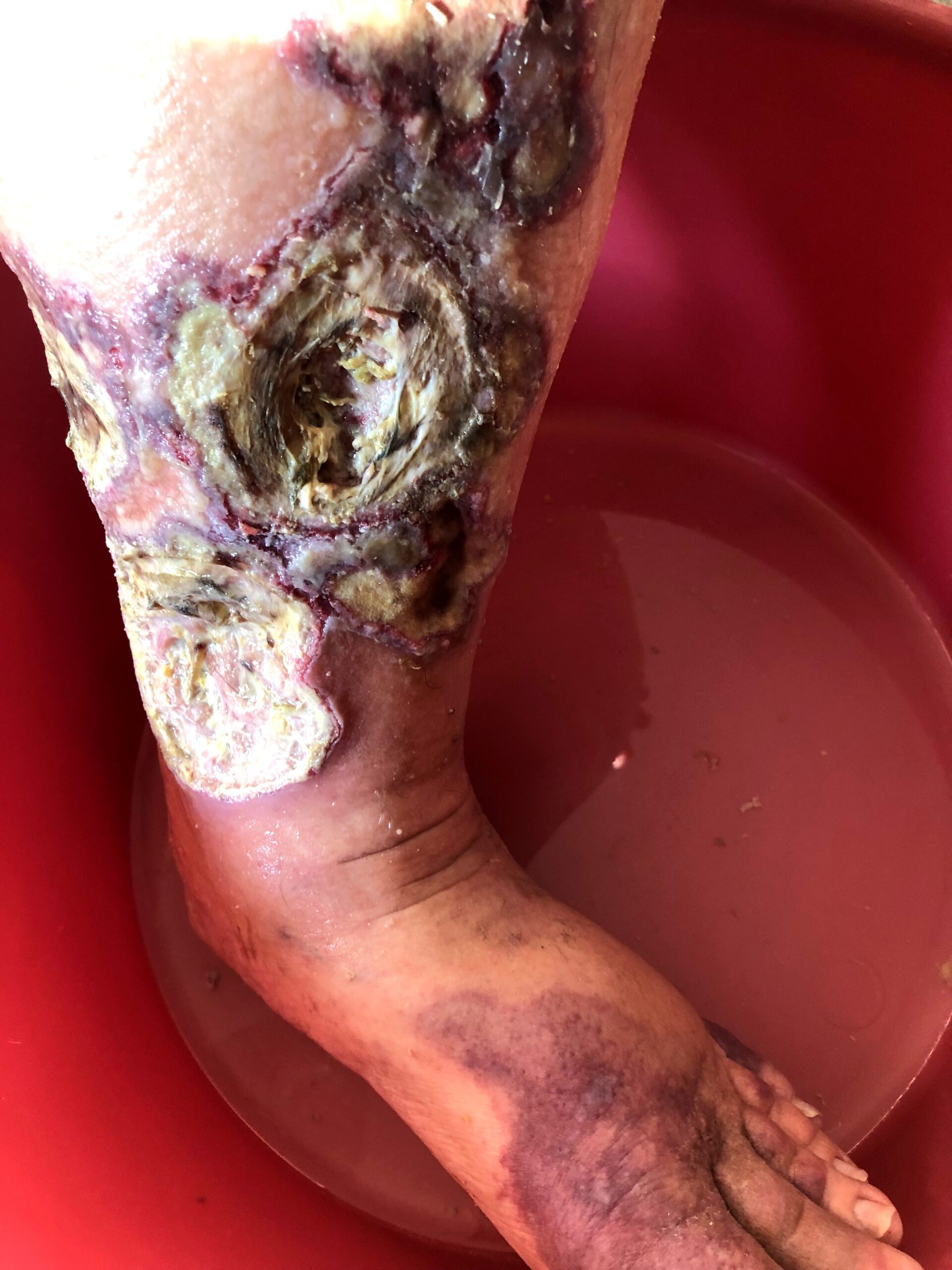 Clinical photograph of pyoderma gangrenosum affecting the lower limb