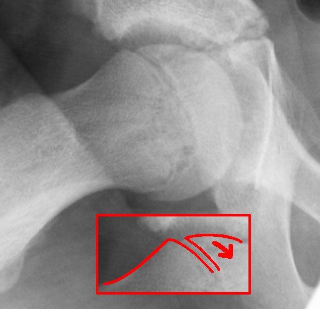 Hip X-ray showing slipped capital femoral epiphysis