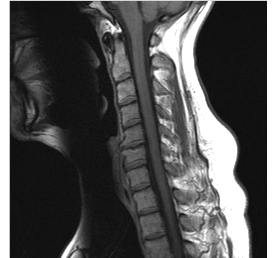 Sagittal T1-weighted cervical MRI showing degenerative changes and osteophytes at C5–6