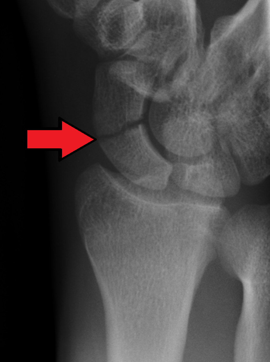 Wrist X-ray showing a scaphoid waist fracture