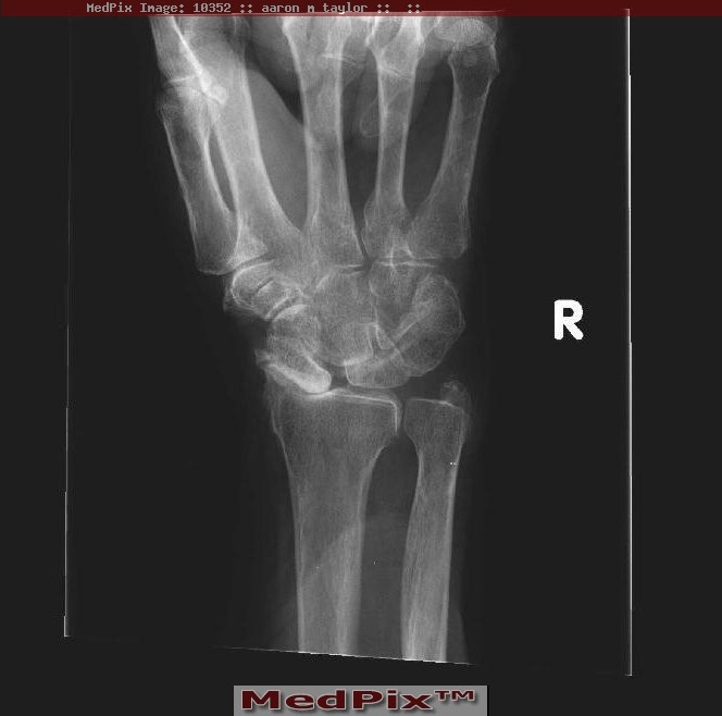 Wrist X-ray showing scapholunate dissociation