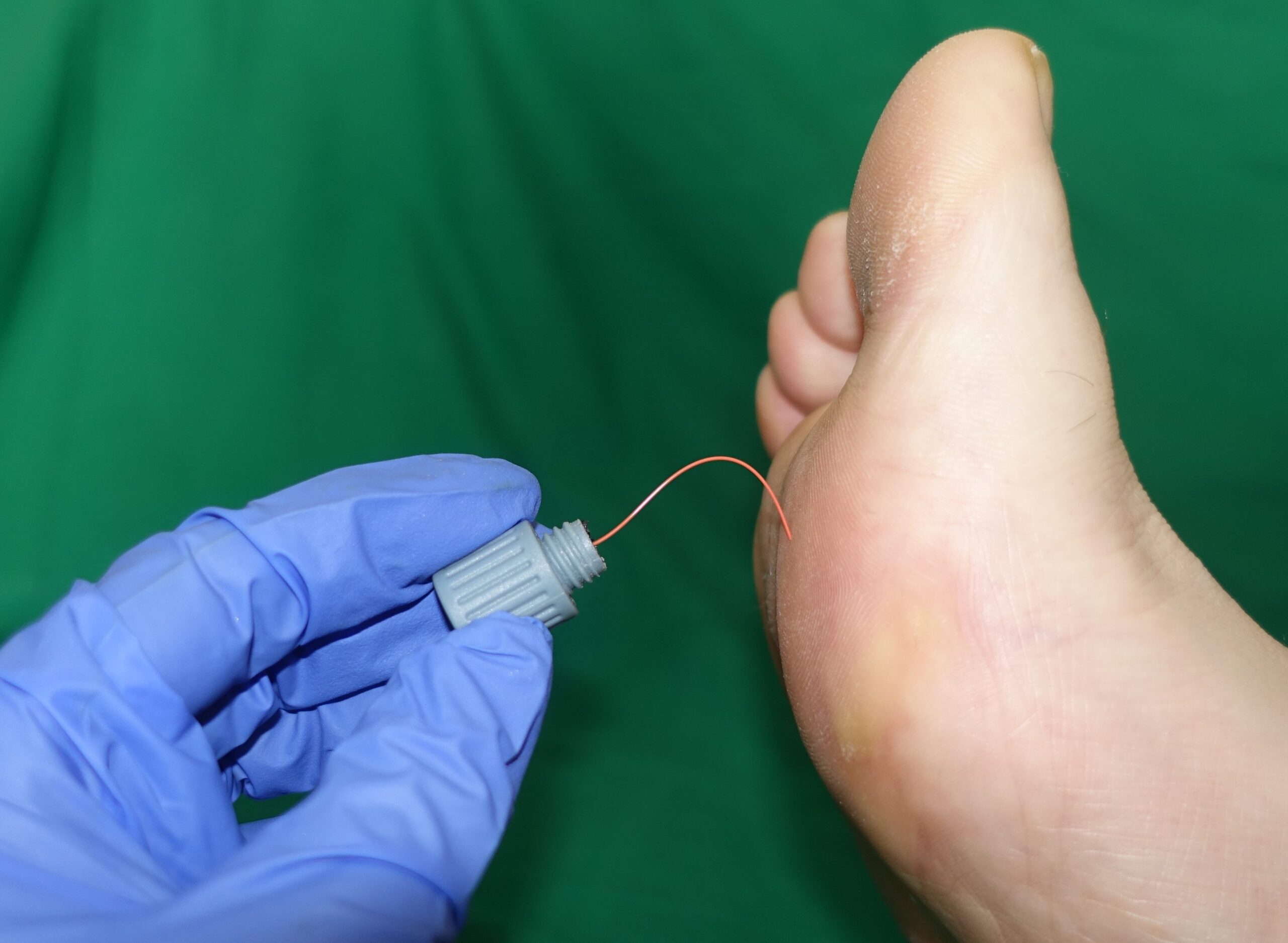 Clinical demonstration of Semmes-Weinstein monofilament testing for protective sensation in the foot
