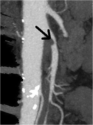 Sagittal CT angiogram demonstrating marked narrowing at the origin of the superior mesenteric artery.