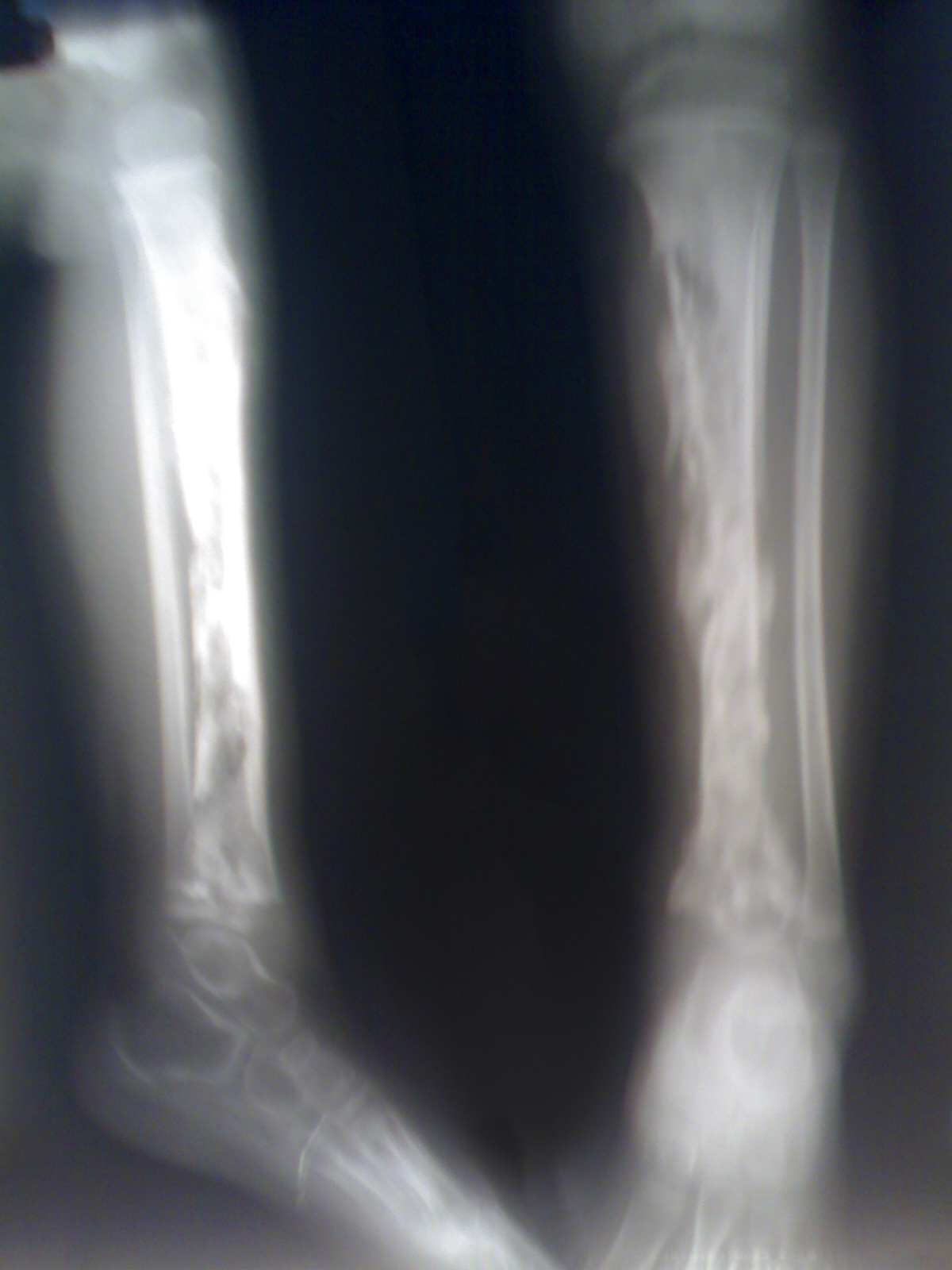 X-ray of childhood tibial osteomyelitis showing radiolucent bone abscesses