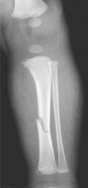 X-ray showing a spiral fracture of the tibia in an infant