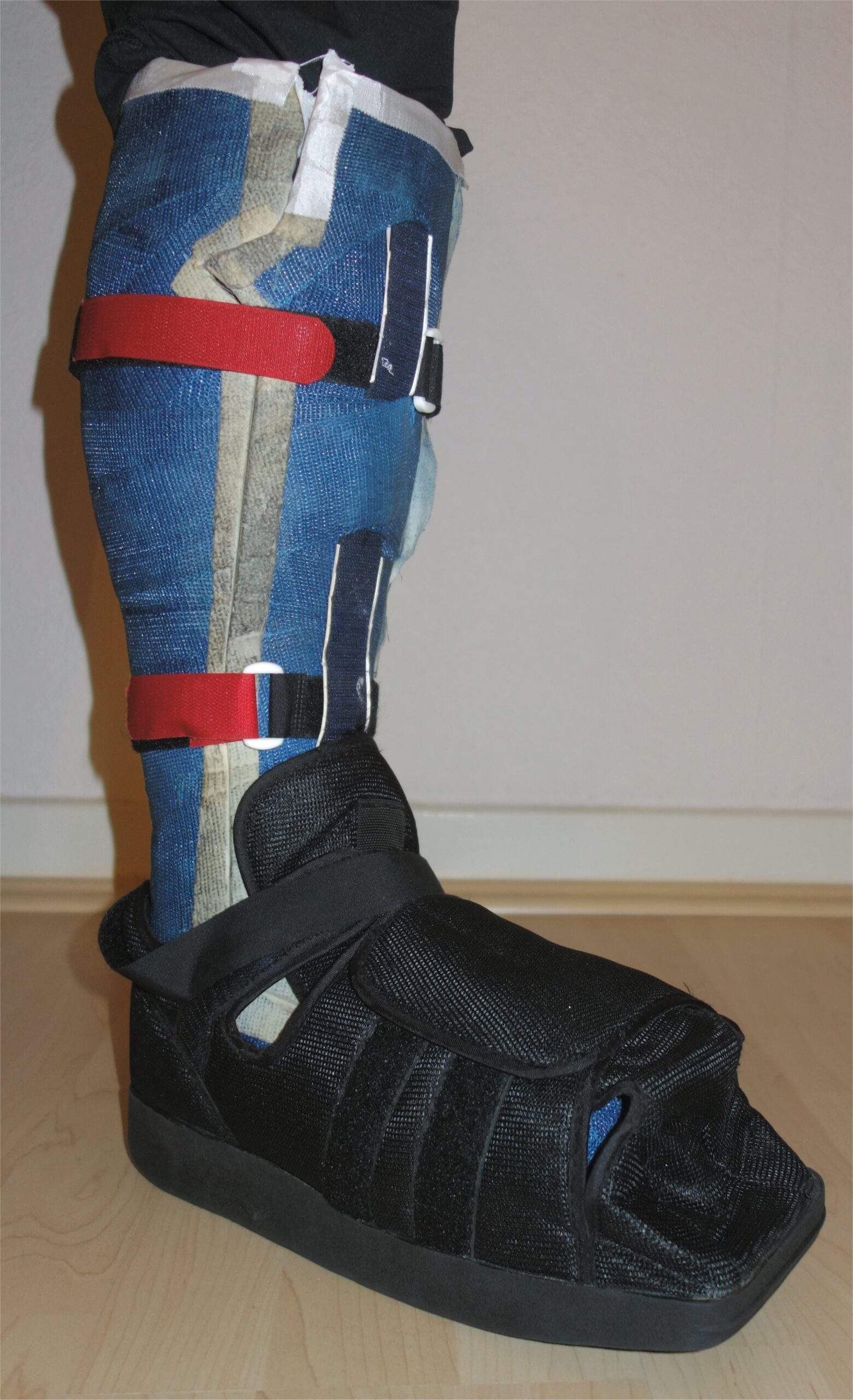 Total contact cast used to offload a diabetic foot ulcer
