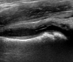 Hip ultrasound showing joint effusion in transient synovitis