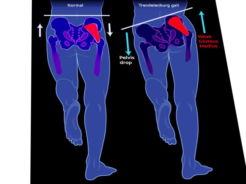 Illustration of Trendelenburg gait showing pelvic drop on the unsupported side
