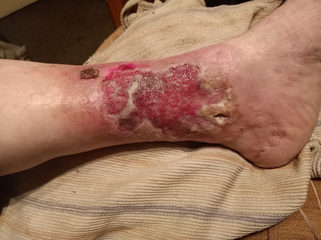 Clinical photograph of a venous leg ulcer caused by chronic venous insufficiency