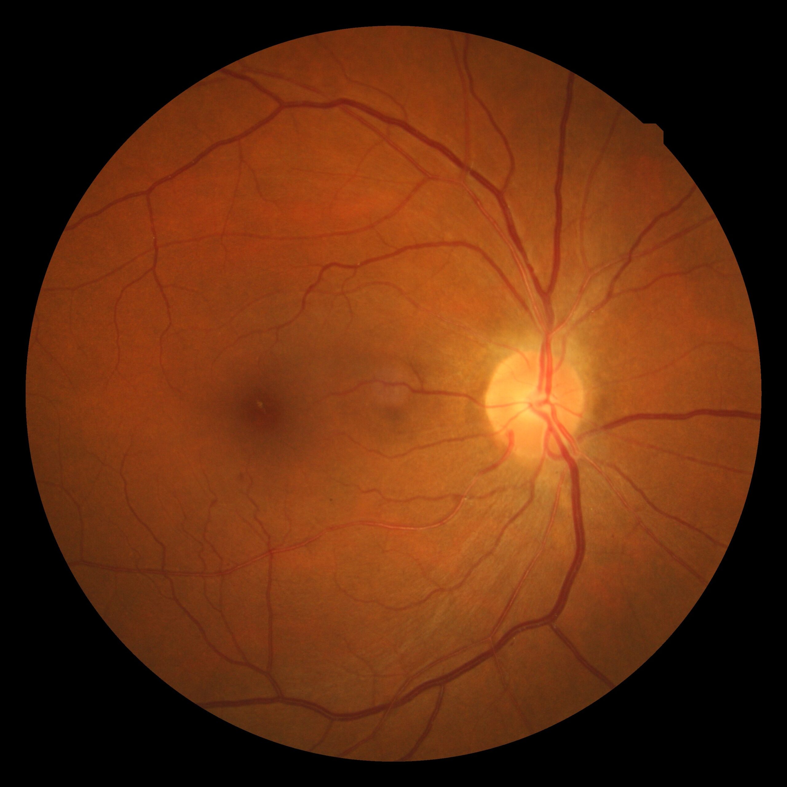 Retinal fundus photograph showing hypertensive retinopathy.