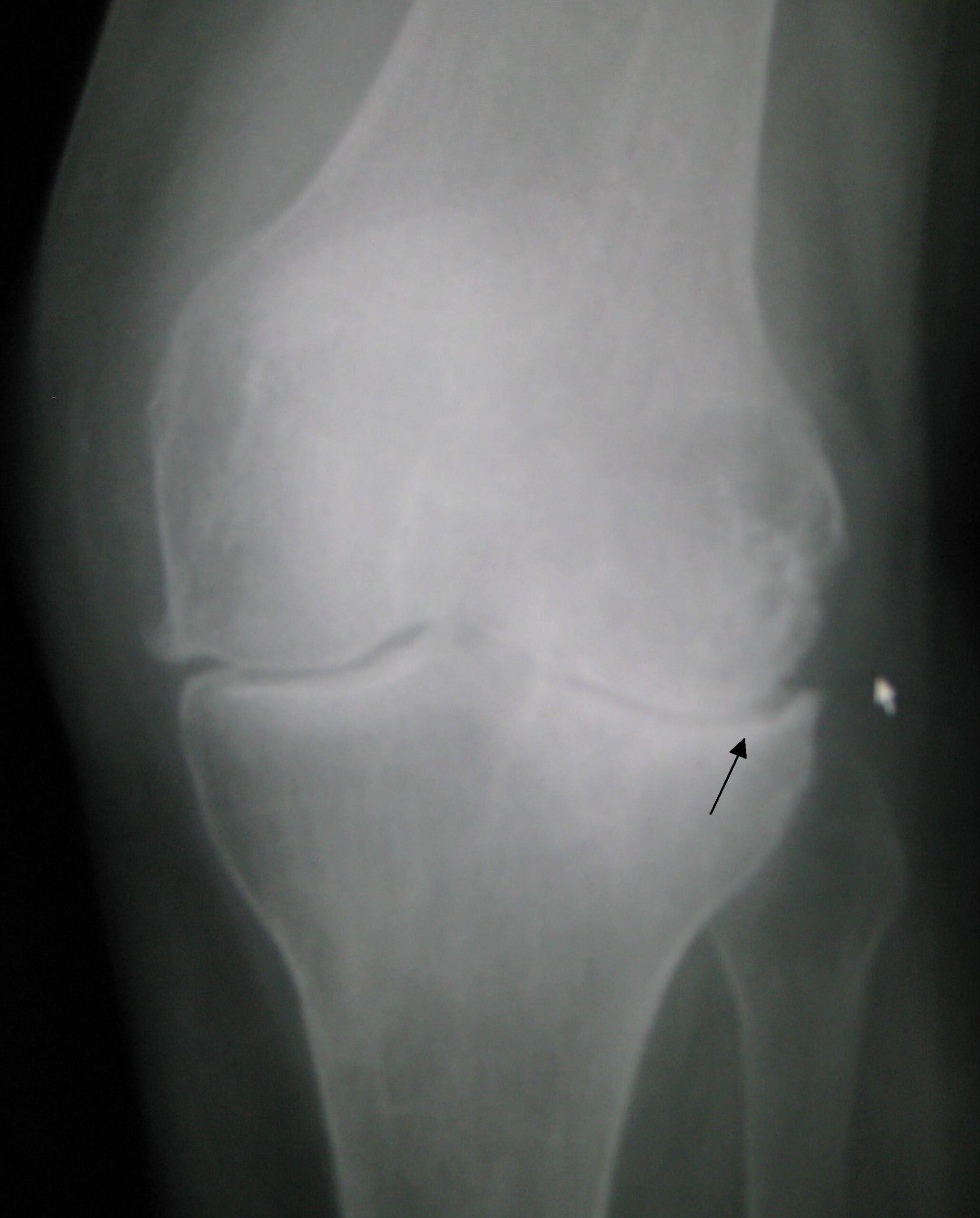 AP radiograph of the left knee with medial joint-space narrowing, subchondral sclerosis and marginal osteophytes.