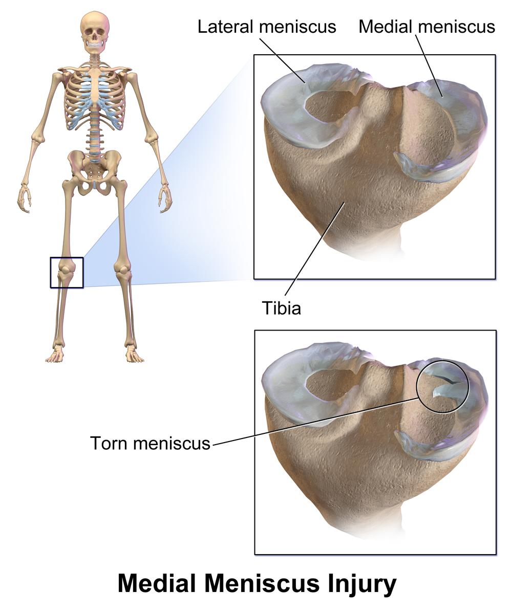 Illustration comparing intact menisci on the tibial plateau with a tear in the medial meniscus.