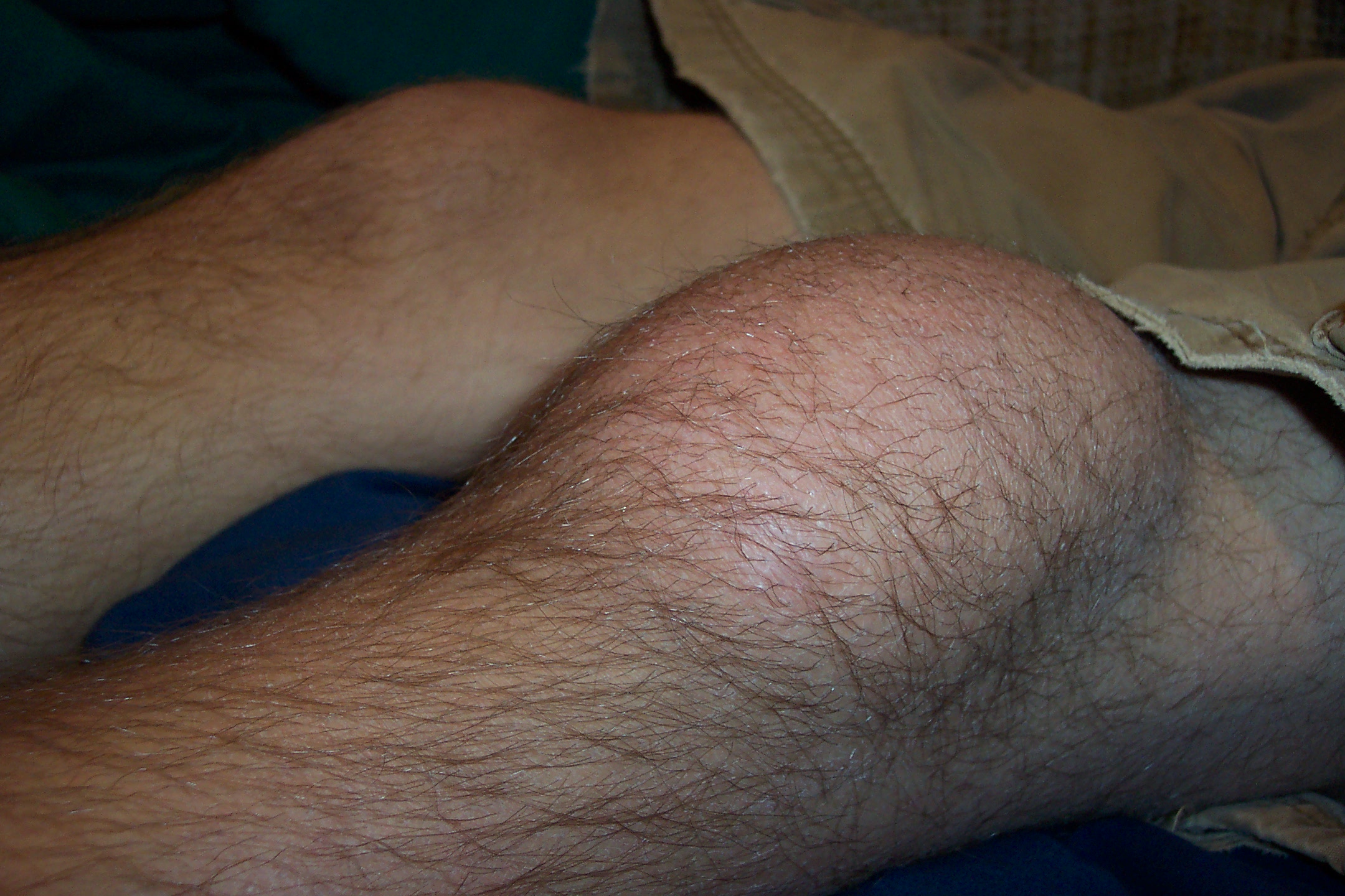 Clinical photograph of prominent localised swelling over the patella, with the other knee visible behind it.